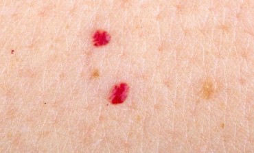 Na koži su vam se pojavile ove crvene tačkice? Evo o čemu je riječ