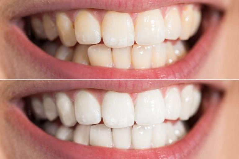 Blistav osmijeh bez odlaska kod zubara: Evo kako da uklonite zubni kamenac