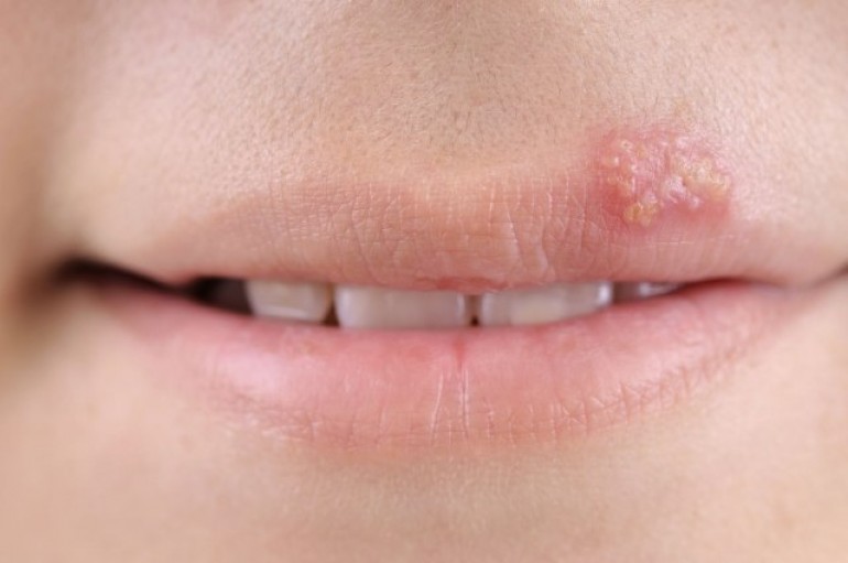 Herpes: Tri savjeta za spriječavanje ranica oko usana